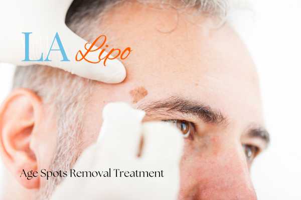 What Are the Most Effective Treatments for Age Spots Stratford-upon-Avon?