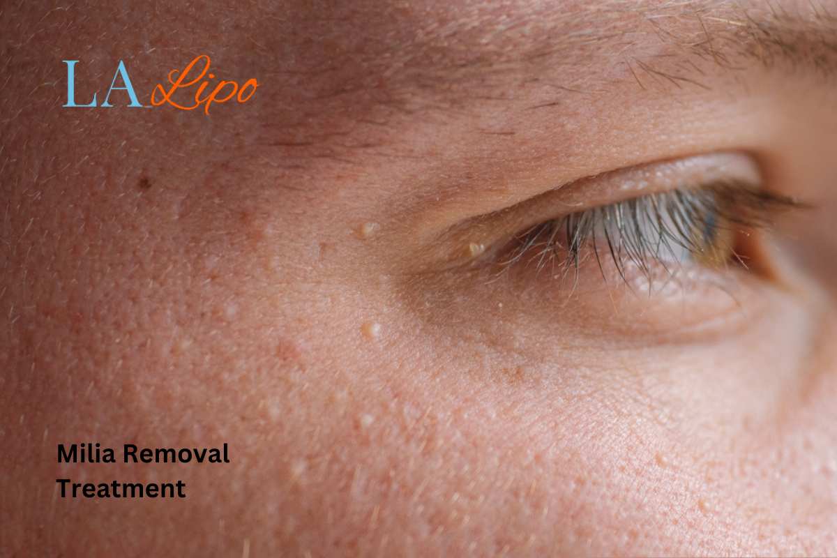 Cryopen Milia Removal: Is It the Easiest and Safest Option Stratford-upon-Avon?