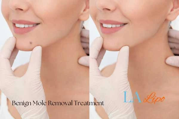 woman's before and after mole removal Stratford-upon-Avon results