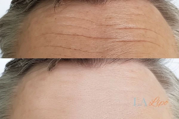 results of HIFU Stratford-upon-Avon on mans forehead to help reduce lines and wrinkles