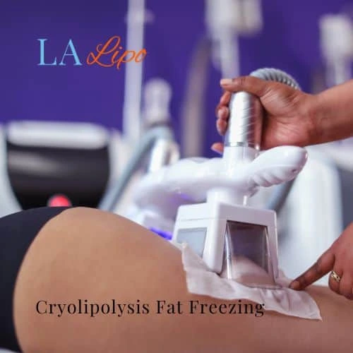 fat freezing - Cryolipolysis Stratford-upon-Avon