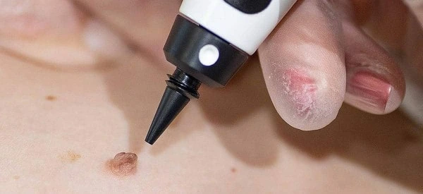 skin tag removal using cryopen Stratford-upon-Avon