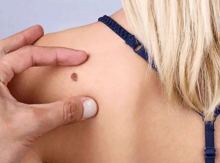 woman having mole removal Stratford-upon-Avon consultation before treatment.