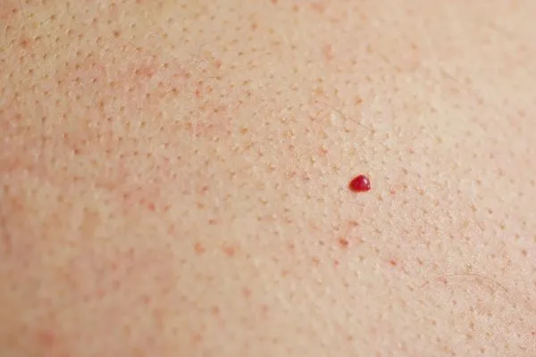 close up of a cherry angioma Stratford-upon-Avon