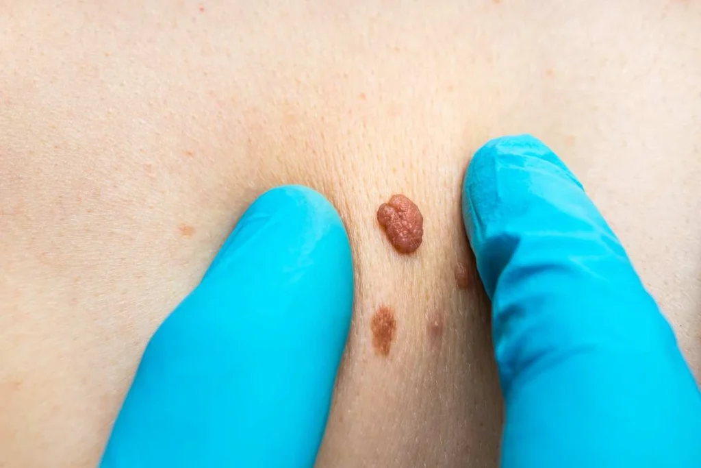 Consultant examining a skin tag Stratford-upon-Avon