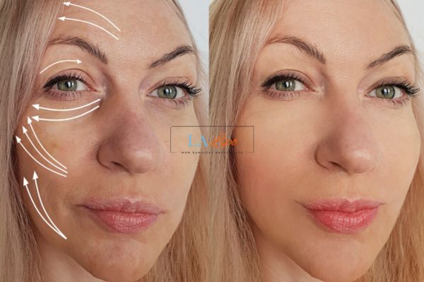 Morpheus 8 results Stratford-upon-Avon face lift.