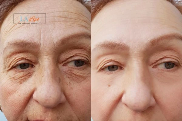 The powerful benefits of Morpheus8 Treatment Stratford-upon-Avon - Call Our team today!