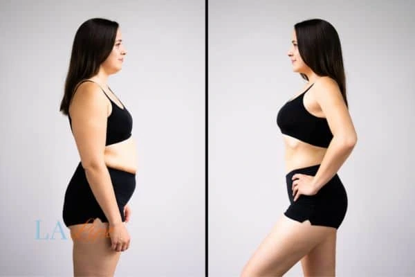 Picture of womans before and after using LA-EMS body sculpting to improve her core strength Stratford-upon-Avon