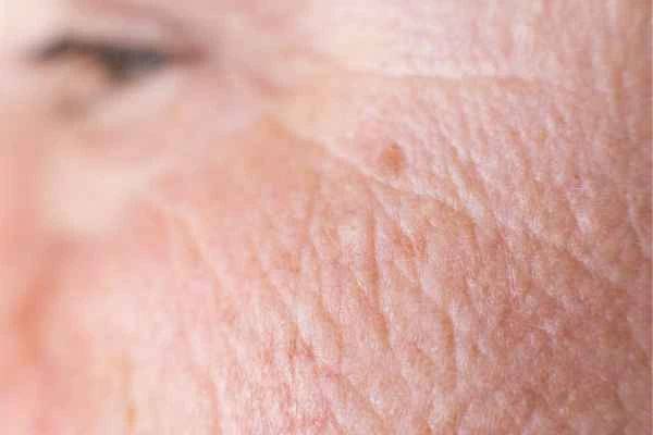 close up picture of a woman's face showing an age spot Stratford-upon-Avon