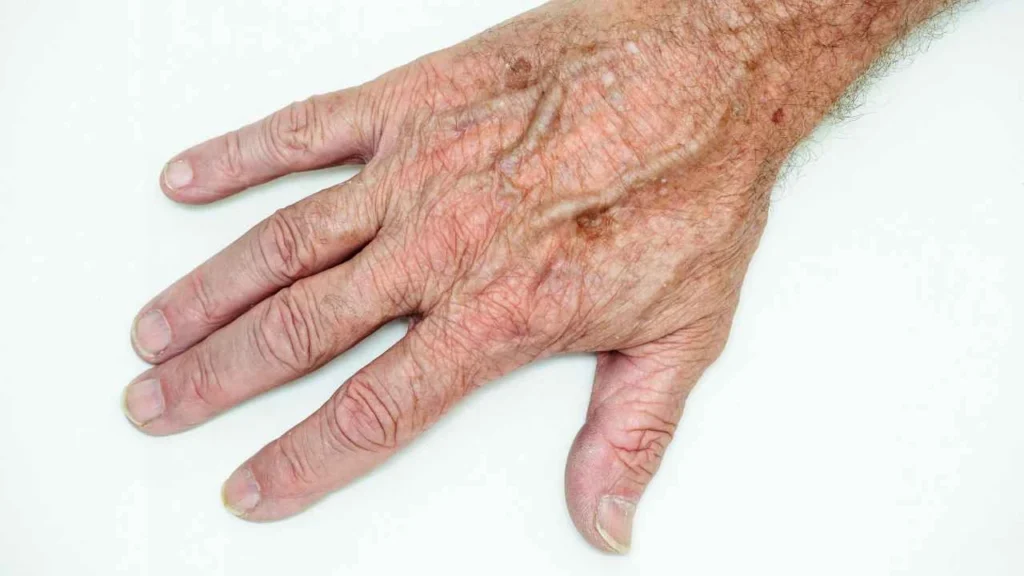 Male hand showing age spot Stratford-upon-Avon