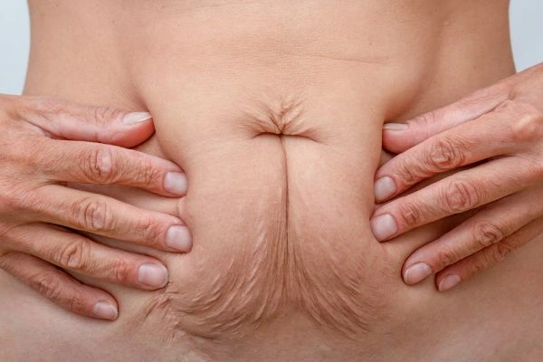Image of a woman's stomach with loose skin - example of skin tightening Stratford-upon-Avon options